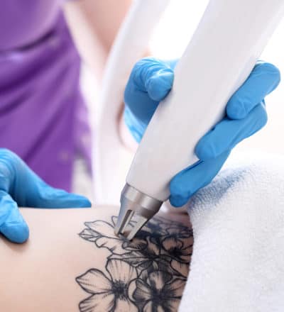 Tattoo Removal
